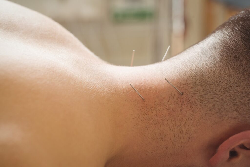 Does Dry Needling Hurt