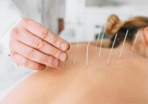 How long do the benefits of dry needling last