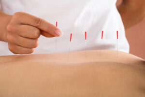 What is is dry needling?