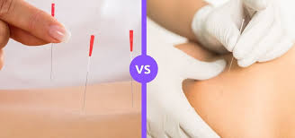 Difference between dry needling and acupuncture