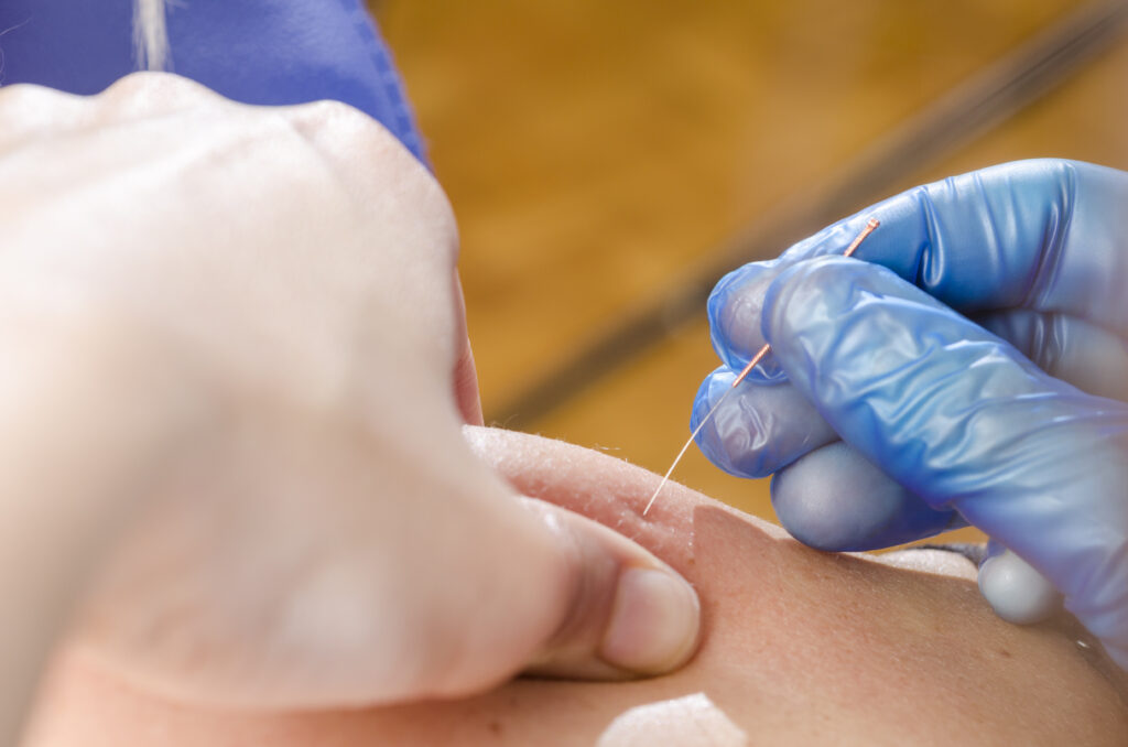 How Long After Dry Needling Can I Exercise