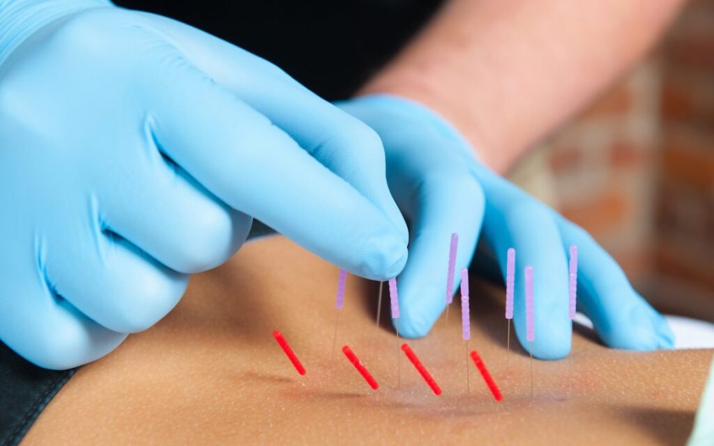 What To Expect After Dry Needling
