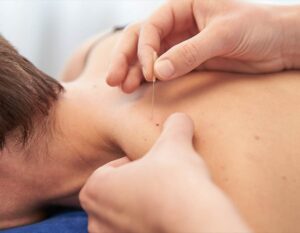 How Long Are You Sore After Dry Needling